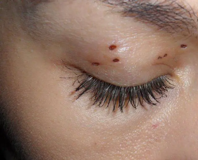 Result of removal of papillomas on the upper eyelid