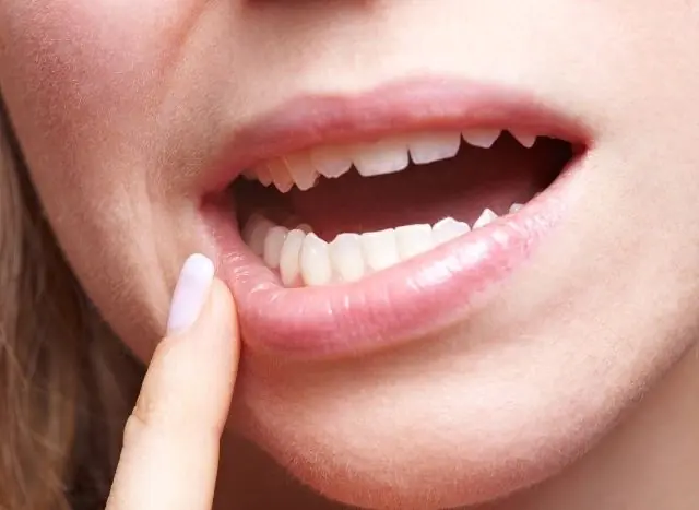 HPV от вътрешната страна на устната
