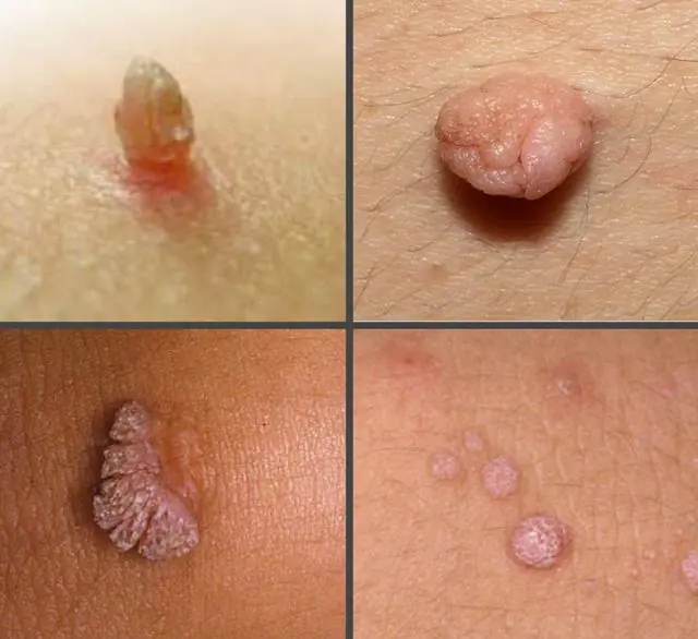 What does papilloma look like on the inner thigh?