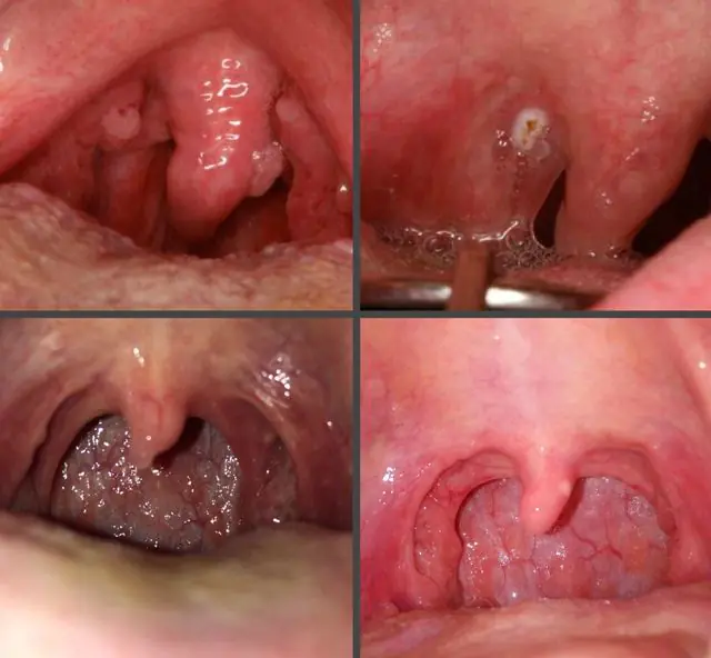 What do papillomas look like on the uvula in the throat?