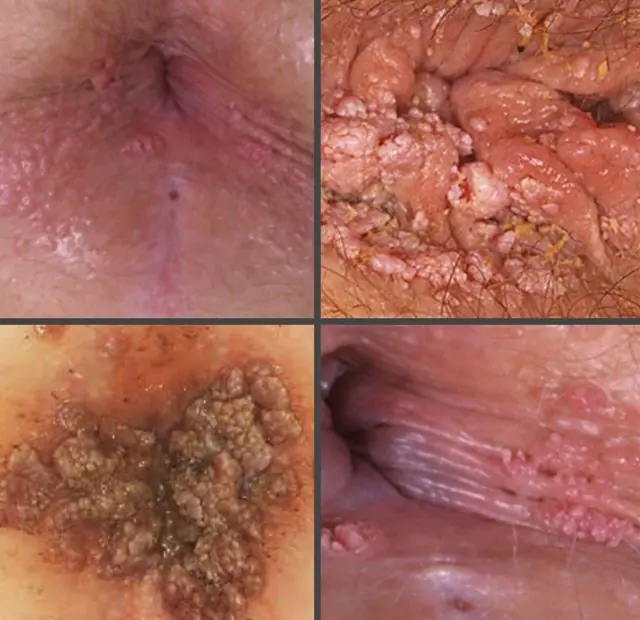 Papillomas in the anus in women