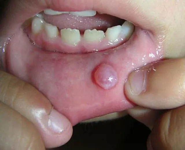 Papilloma in bocca