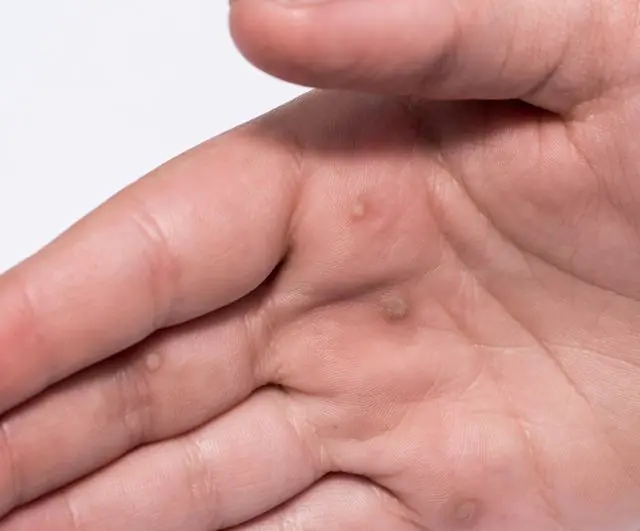 유두종은 손에 어떻게 생겼습니까?