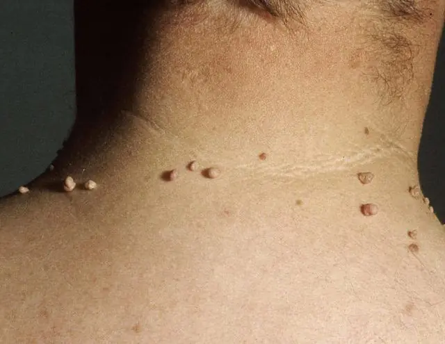Papilomas no pescoço de um homem