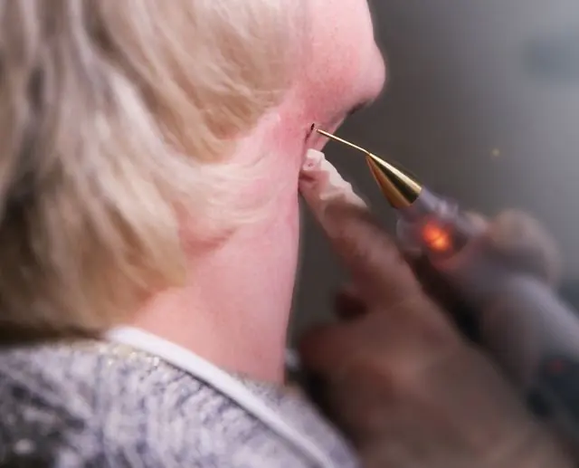 Laserverwijdering van papilloma in de nek