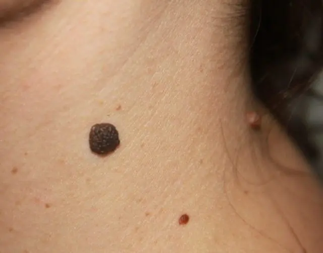 What do papillomas on the neck look like?