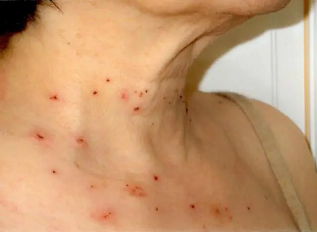 Results of treatment of papillomas on the neck