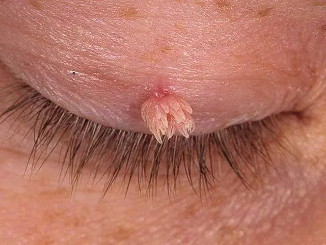 Göz qapaqlarında HPV