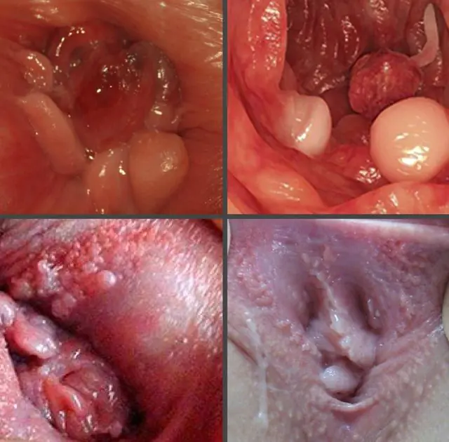 What do papillomas look like in the urethra in women?
