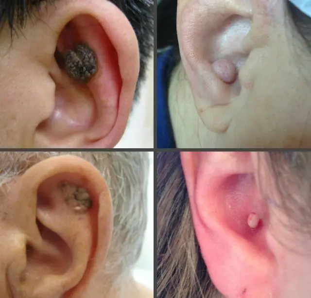 人耳中的乳头状瘤是什么样子？