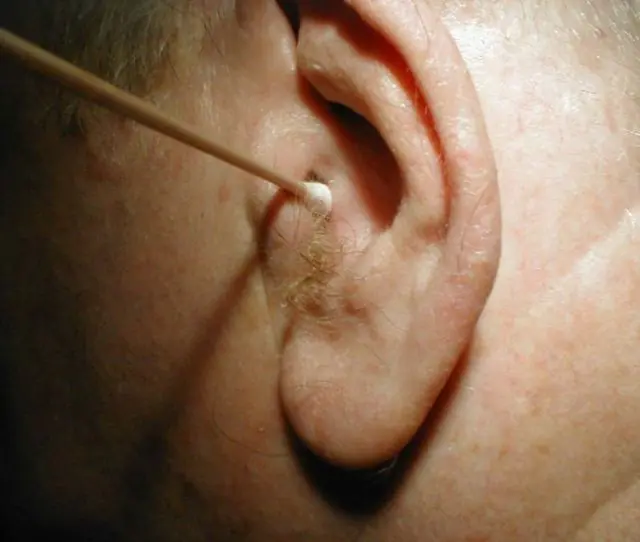 Cauterization of papillomas in the ears