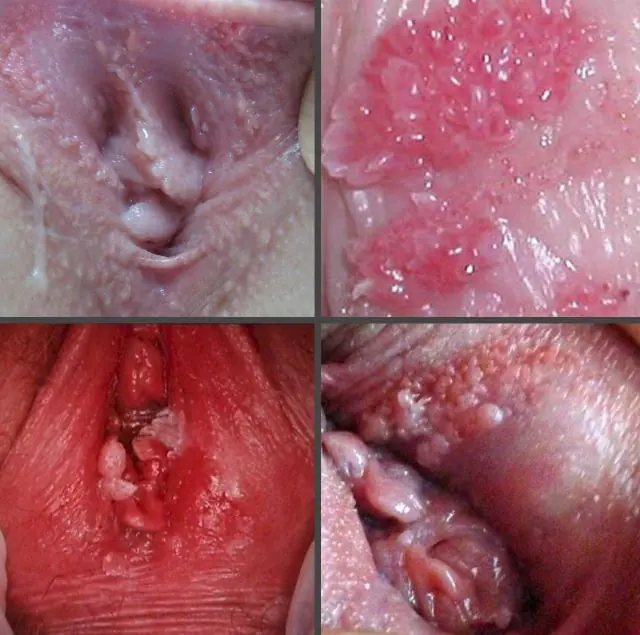 What do papillomas in the vagina look like?