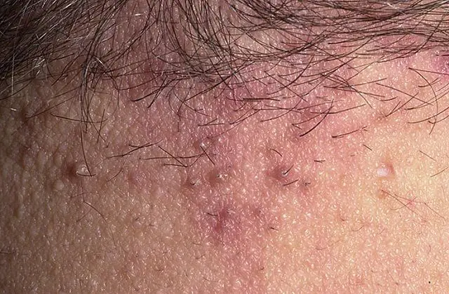 Folliculitis on the back of the neck