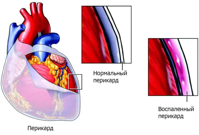 Norma and pericarditis