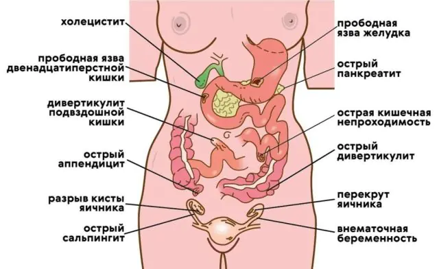 Penyebab peritonitis
