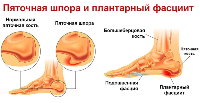足底筋膜炎的症状