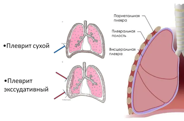 Pleurisy of the lungs
