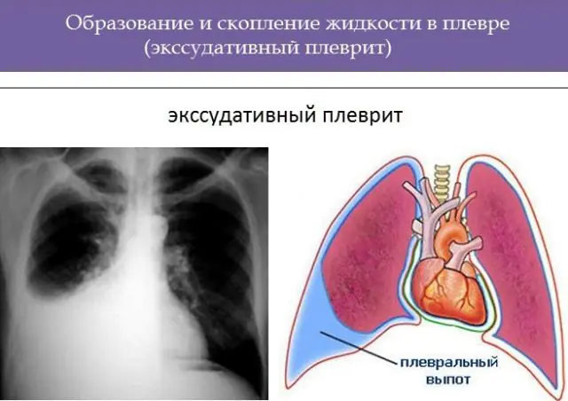 Exudatieve pleuritis van de longen