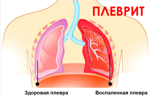Pleuritis van de longen
