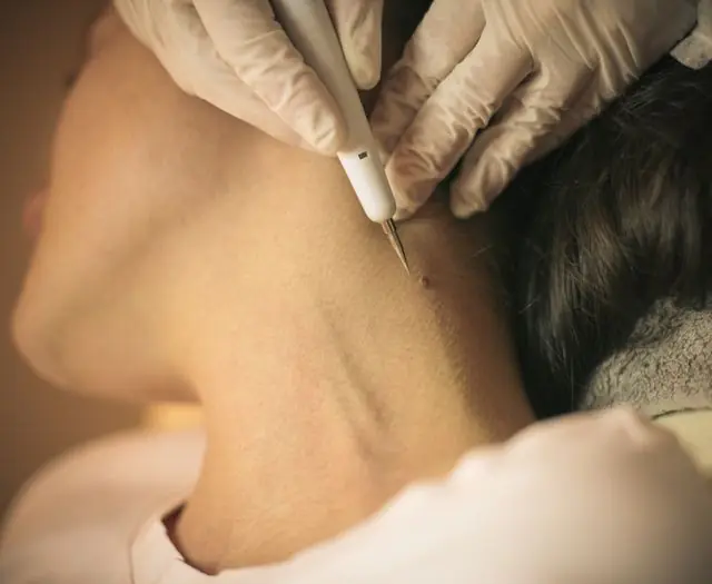 Removal of papillomas on a woman’s neck