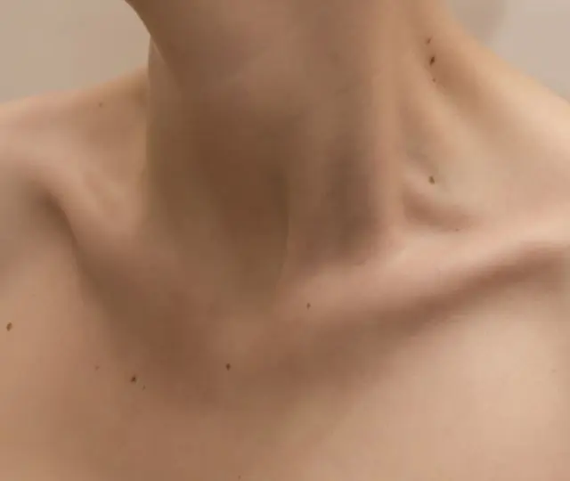 Papilomas no pescoço