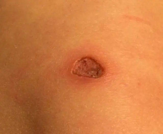 Wound after papilloma removal