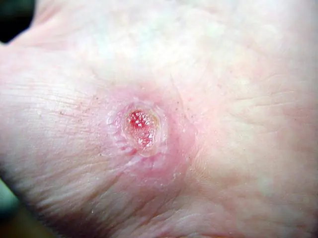 The wound does not heal after removal of the papilloma