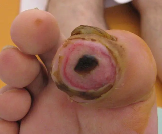 Wound infection after papilloma removal