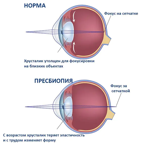 olhos de presbiopia
