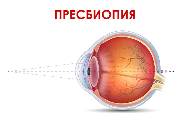 Presbyopia silmät
