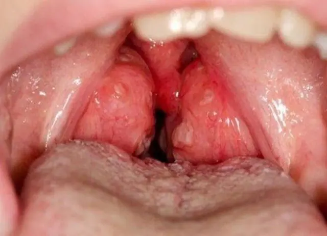 Causes and treatment of papilloma on the tonsil