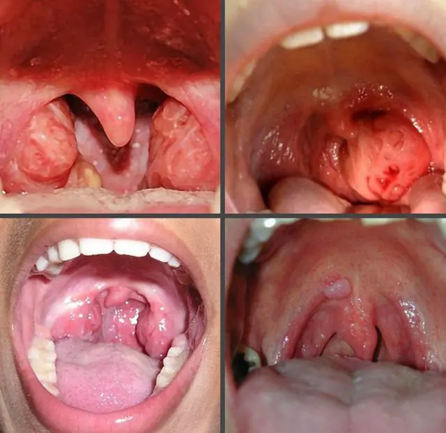 Che aspetto hanno i papillomi sulle tonsille nei bambini?