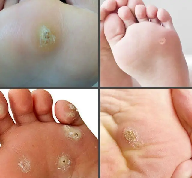 Hvordan ser papilloma ud på et barns fod?