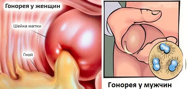 Schematisk representation av gonorrésymptom hos både män och kvinnor