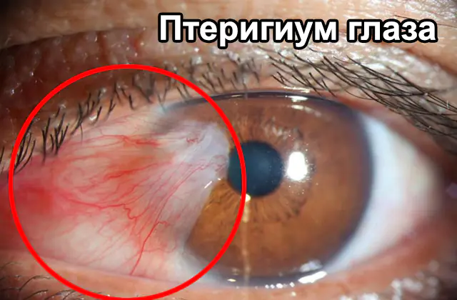 Pterygium øyne