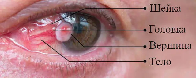 pterygium of the eye