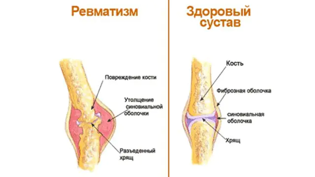 Rheumatism of the joints
