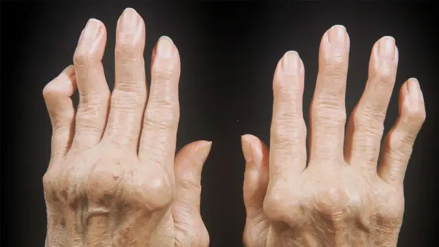 rheumatism of the hands