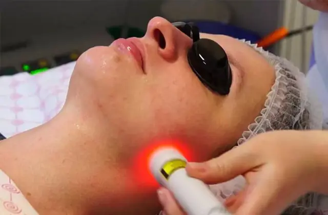 Laser therapy against erysipelas