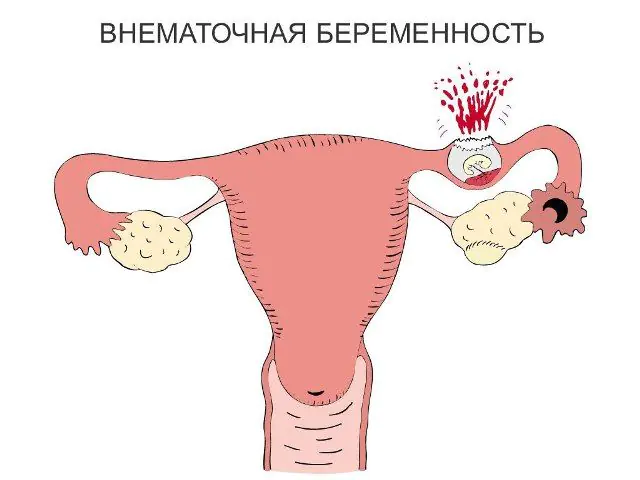 卵管炎の合併症としての子宮外妊娠