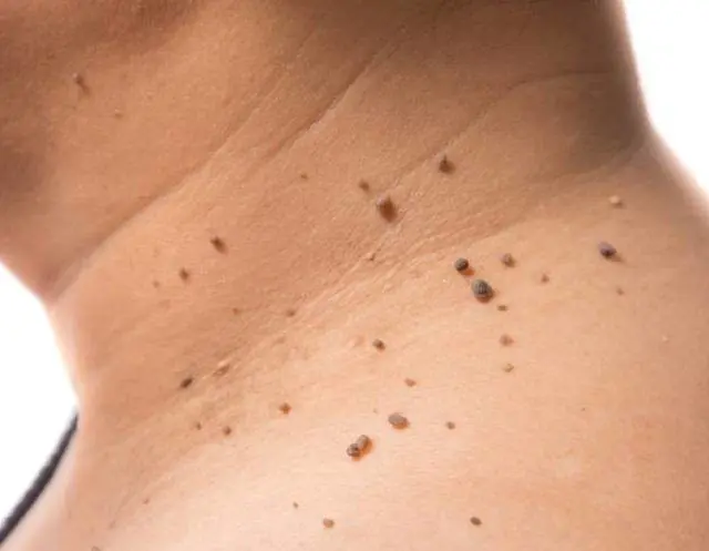 Papillome am Körper als Indikation für die Anwendung von Sani Skin