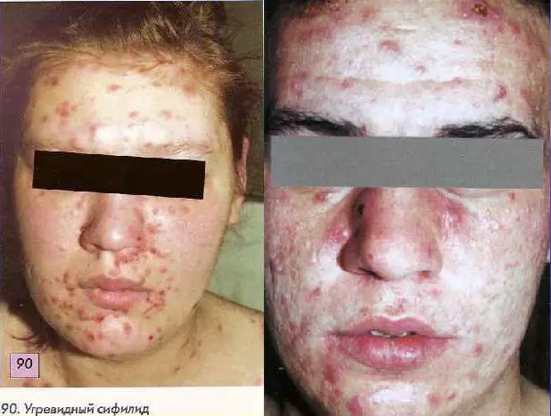 Syphilitic folliculitis in women on the face