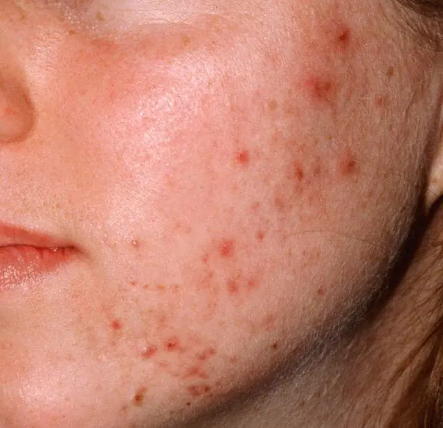 Acne syphilide at the initial stage