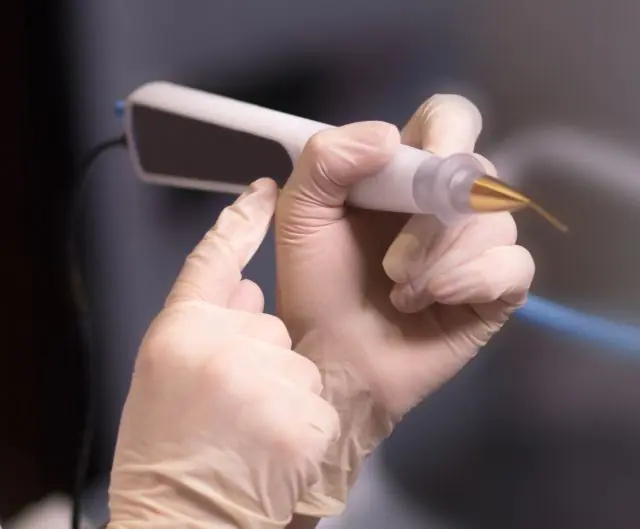 Лазерно отстраняване на папиломи на сливиците на гърлото