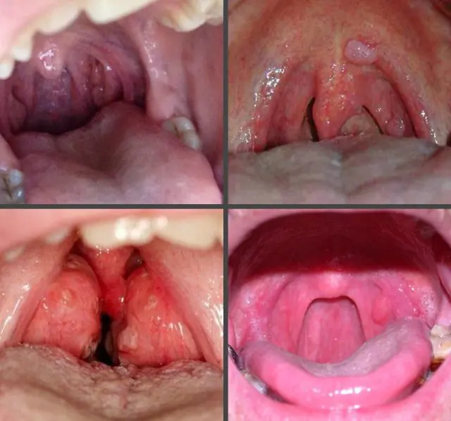 What do papillomas on the tonsil look like?