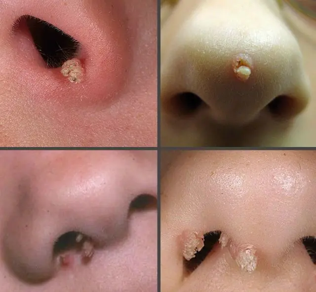Hoe ziet papilloma eruit op de neus van een kind?