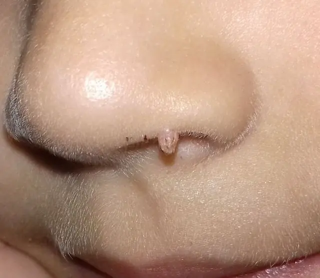 Papiloma en la nariz