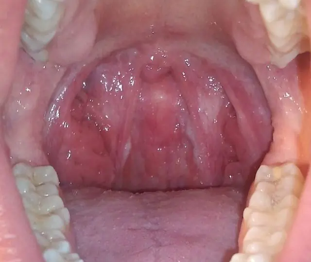 Papillomas on the tonsil