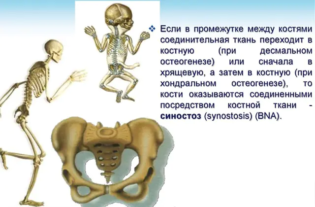 Reasons for the development of synostosis