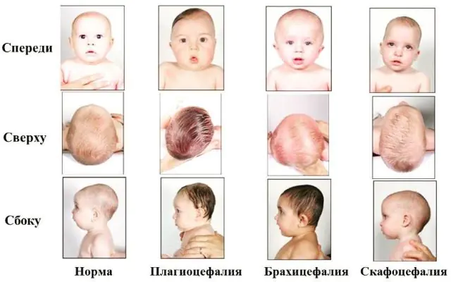 Craniostenosis